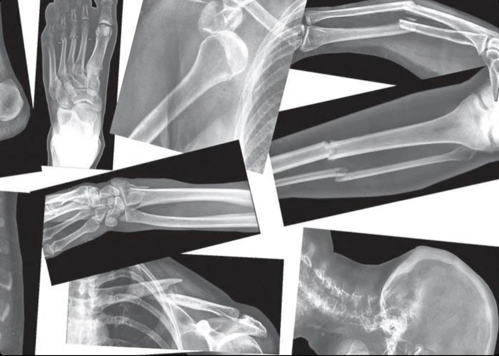 Kids broken bone x-rays for dramatic play and learning, fake x-rays to learn about broken bones. 